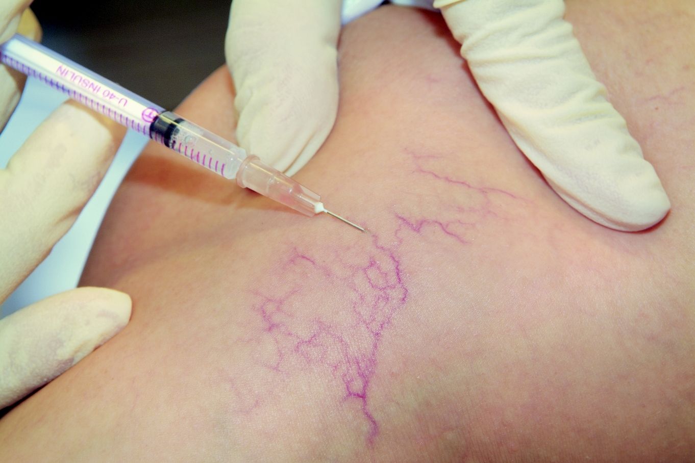 Scleroterapie: Tratamente Vase Sparte/Telangiectazii