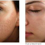 Microneedling Medical
