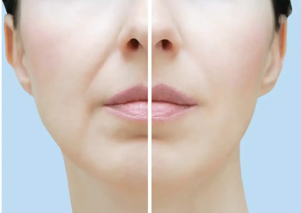 Riduri nazogeniene - CDerma Clinique, Constanța