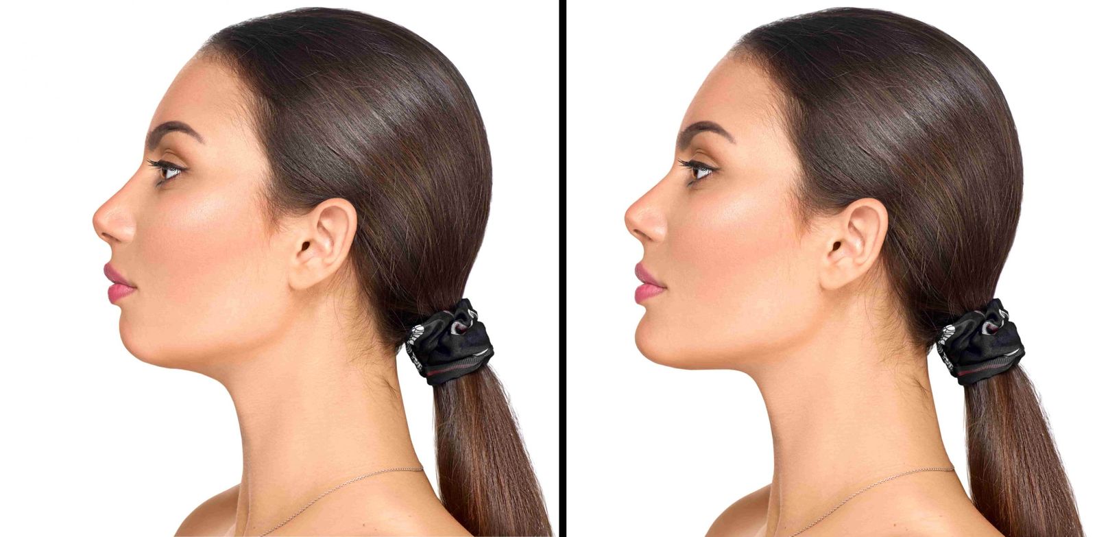 Reconturare mandibulară nechirurgicală cu acid hialuronic