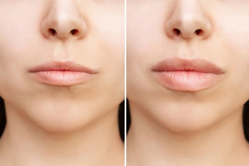Topire Acid Hialuronic - CDerma Clinique, Constanța